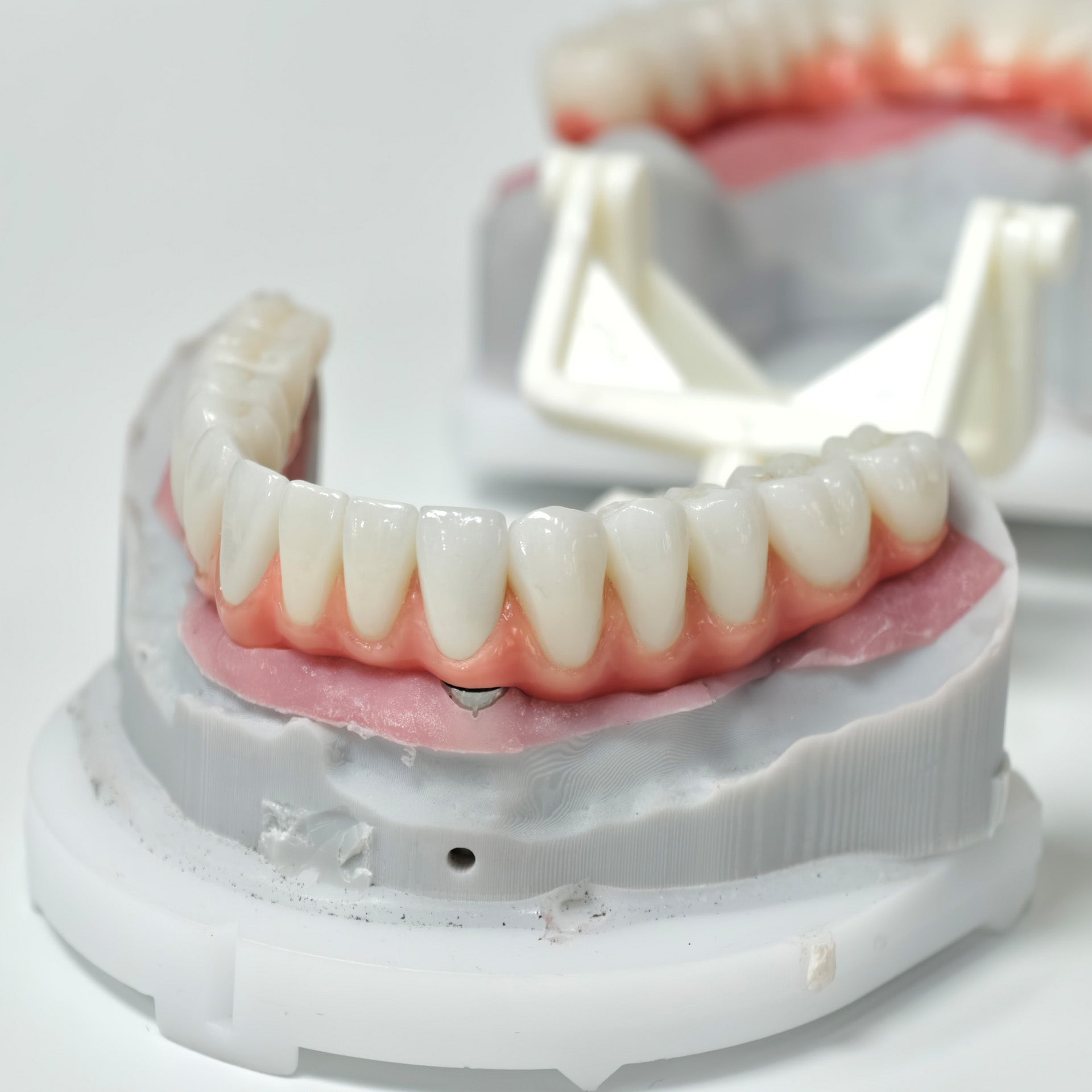 Zirconia-Enamel Hybrid Malo Bridge