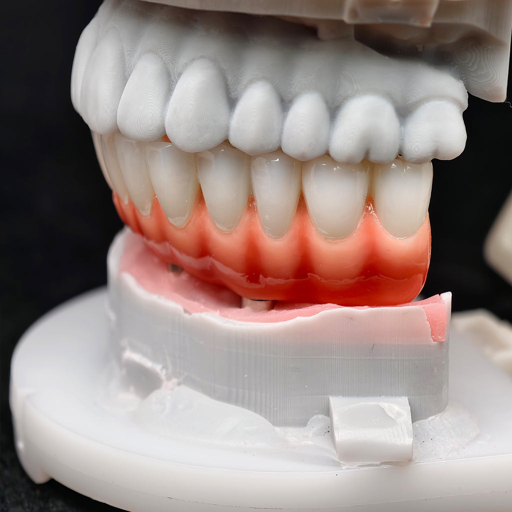 Zirconia-Enamel Hybrid Malo Bridge
