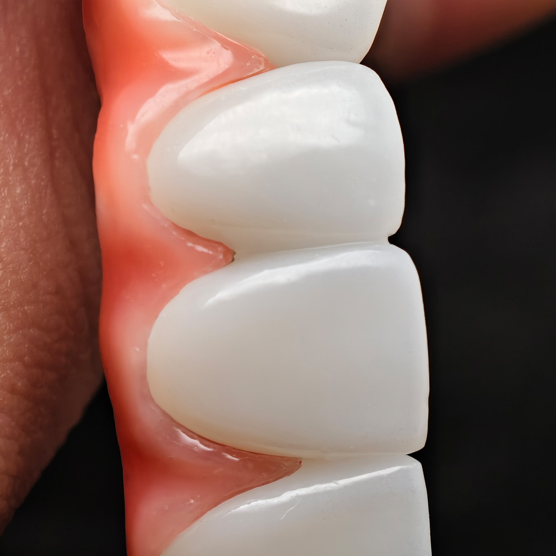 Zirconia-Enamel Hybrid Malo Bridge