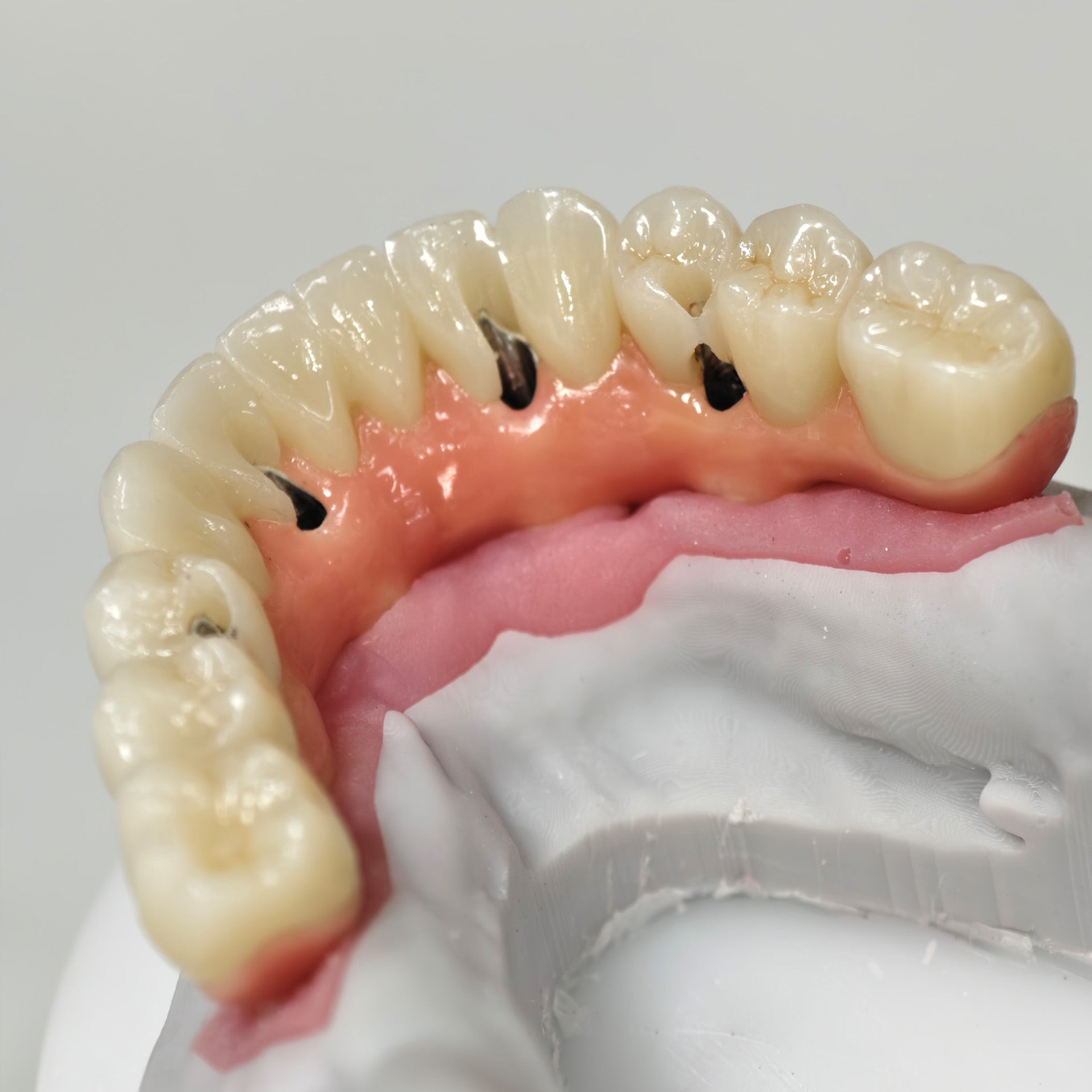 Zirconia-Enamel Hybrid Malo Bridge
