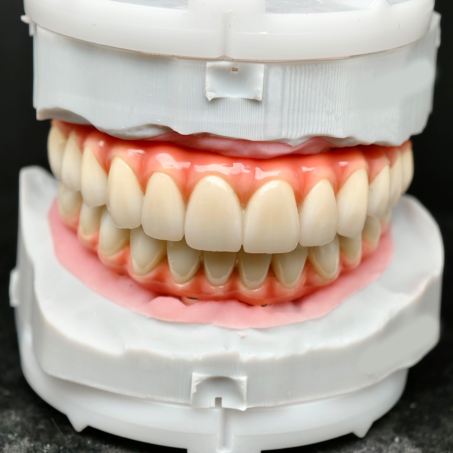 Zirconia-Enamel Hybrid Malo Bridge