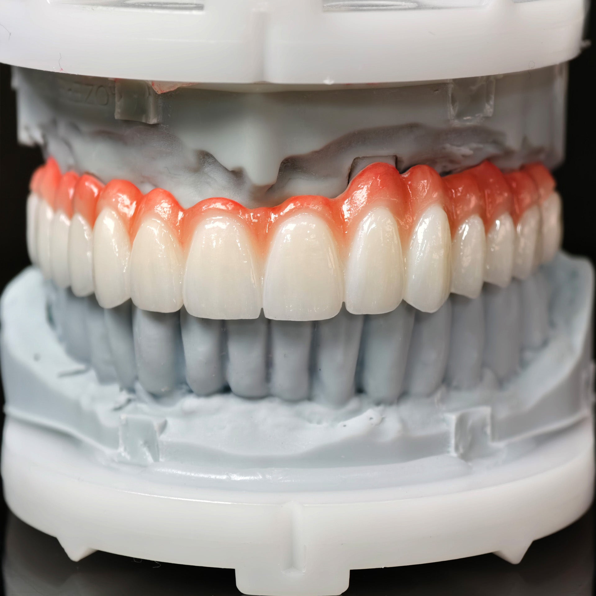 Zirconia Bridge With Cement Retained And Titanium Bar