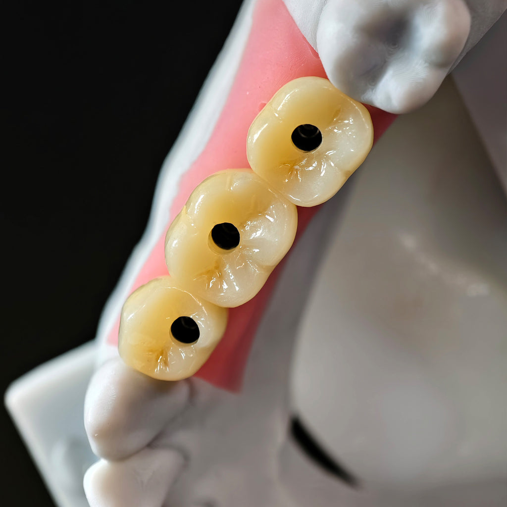 Zirconia Crowns With Gold-Plated Abutment And Implant Seating Guide