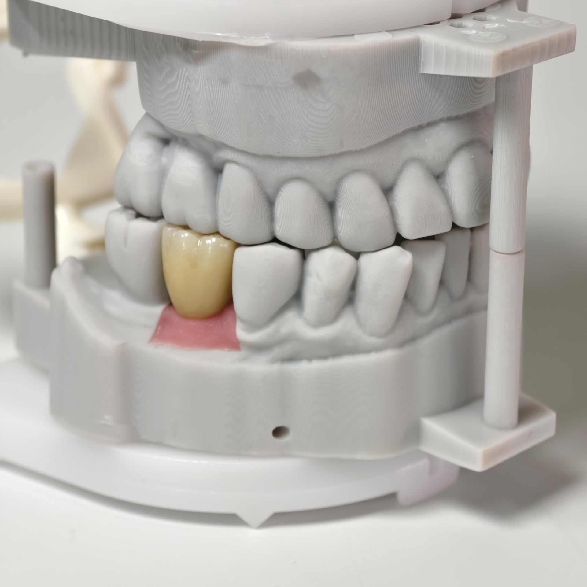 Zirconia Crowns With Screw Retained