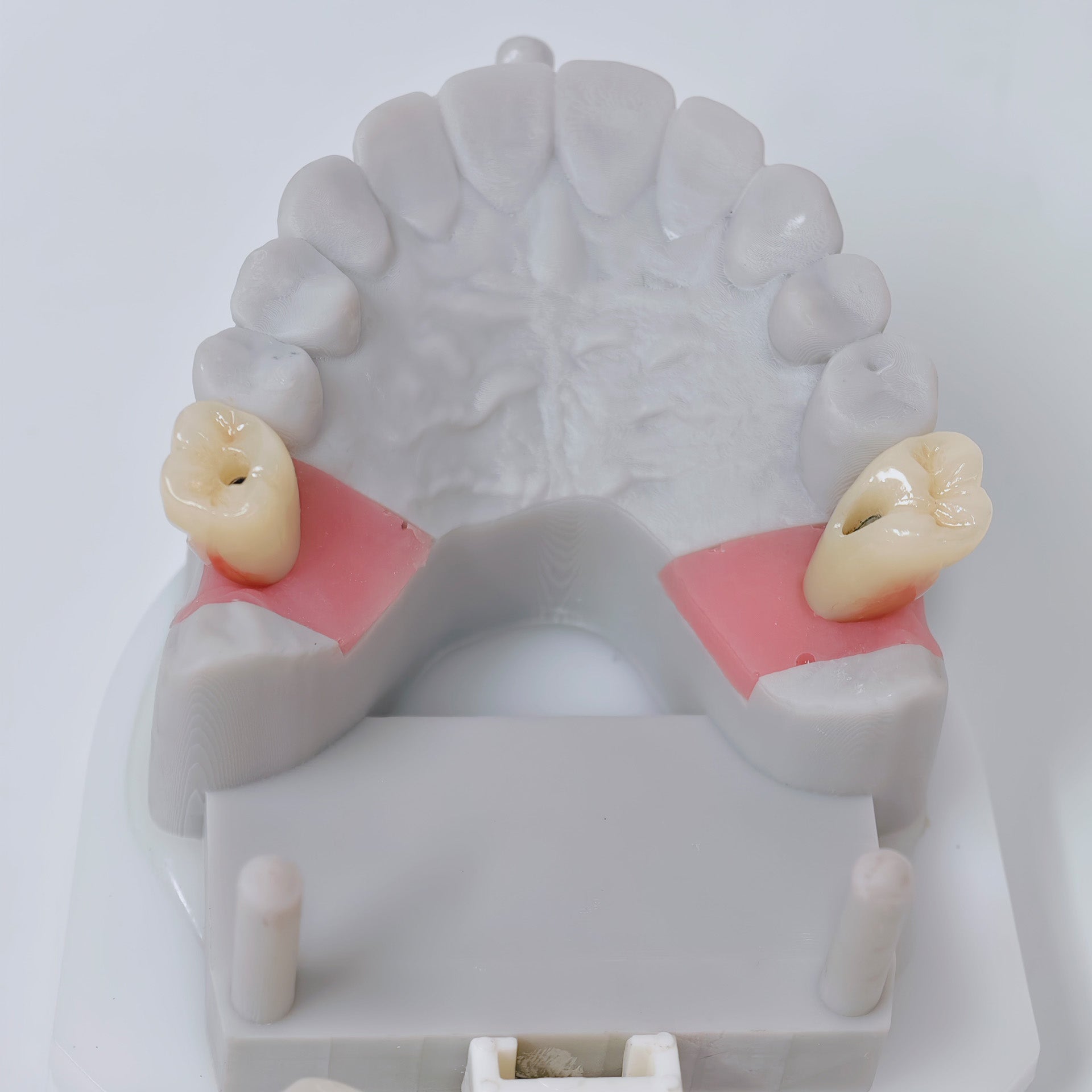 Zirconia Crowns With Screw Retained