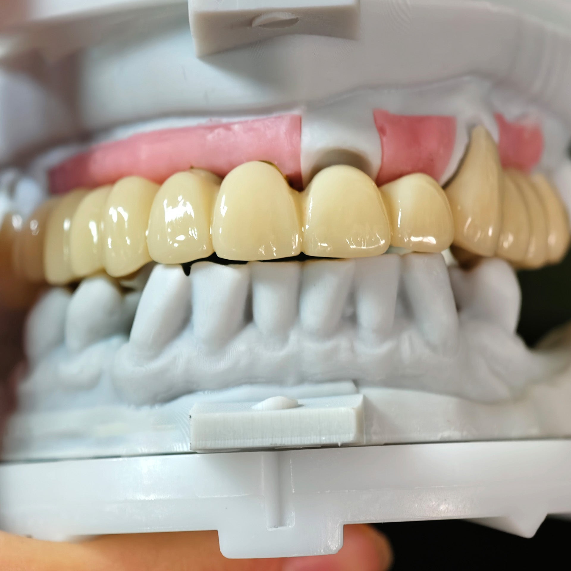 Zirconia Implant Bridge Screwmentable Dental Crown
