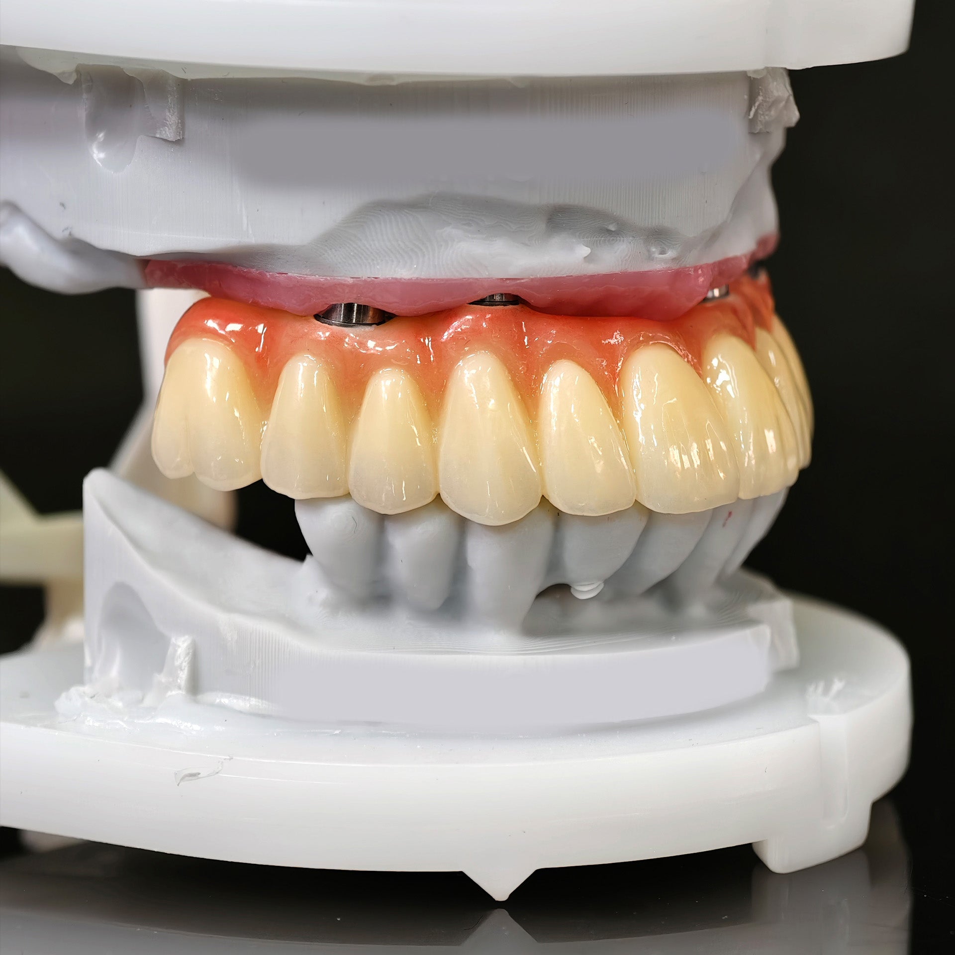 All On 5 Zirconia Bridge With Ti-Base Screw Retained Trying For Full Arch Restoration