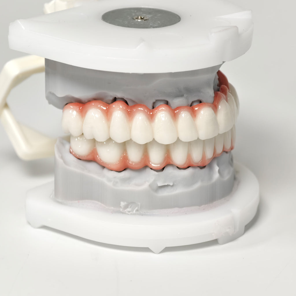 Full-Arch PFM Bridge With Screw Retained