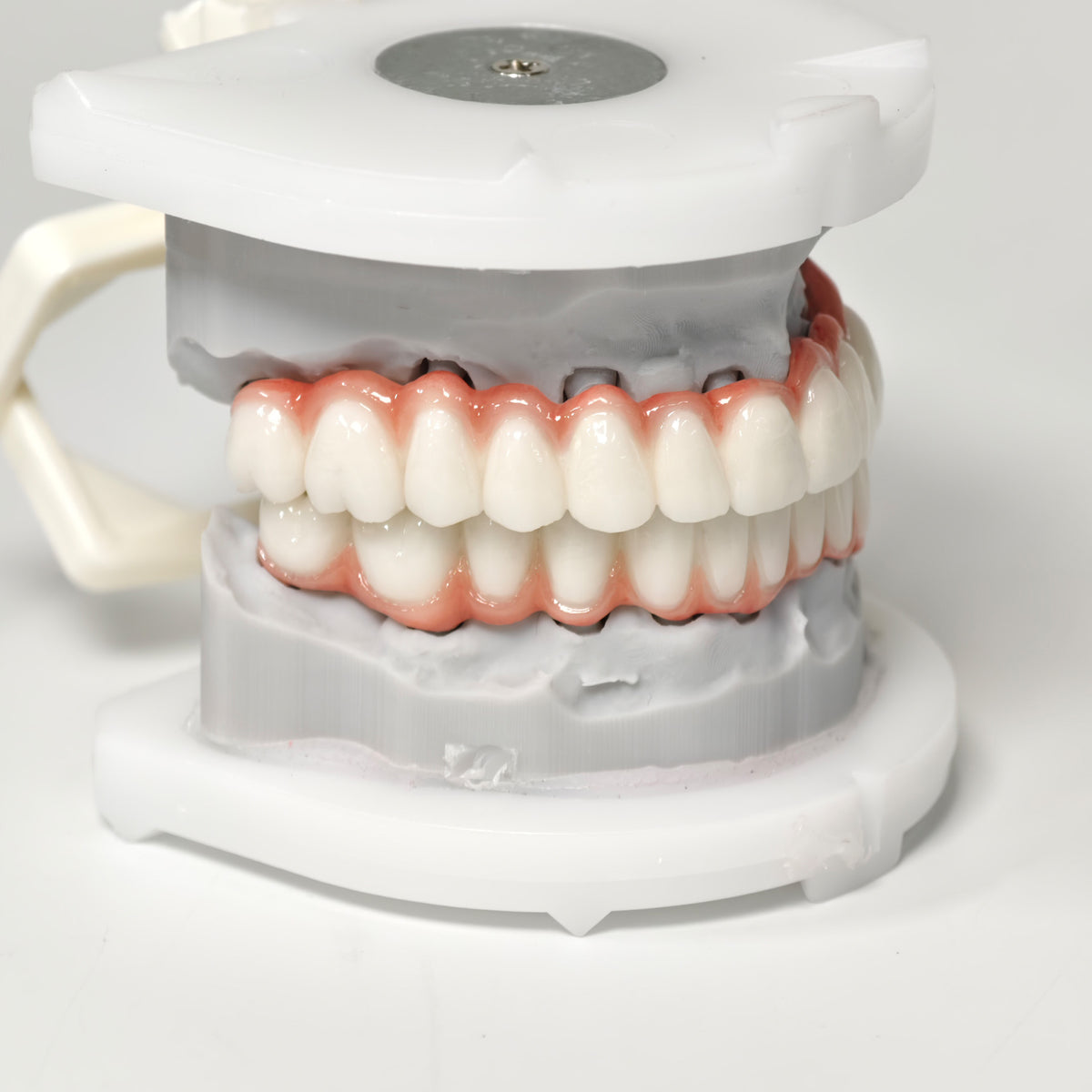 Full-Arch PFM Bridge With Screw Retained
