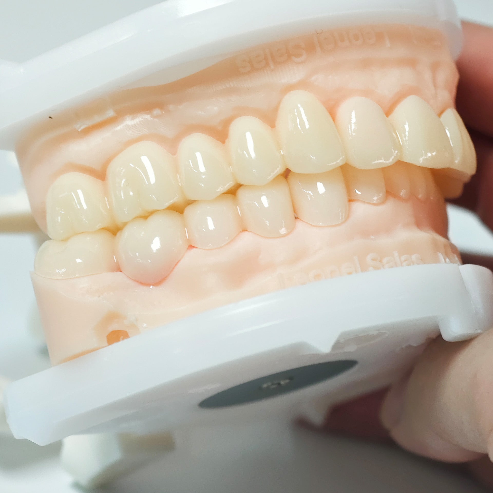 Full-Mouth Segmented PMMA Bridge With Cement Retained