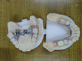 Cocr Framework Denture Laser Printing Good Fitting