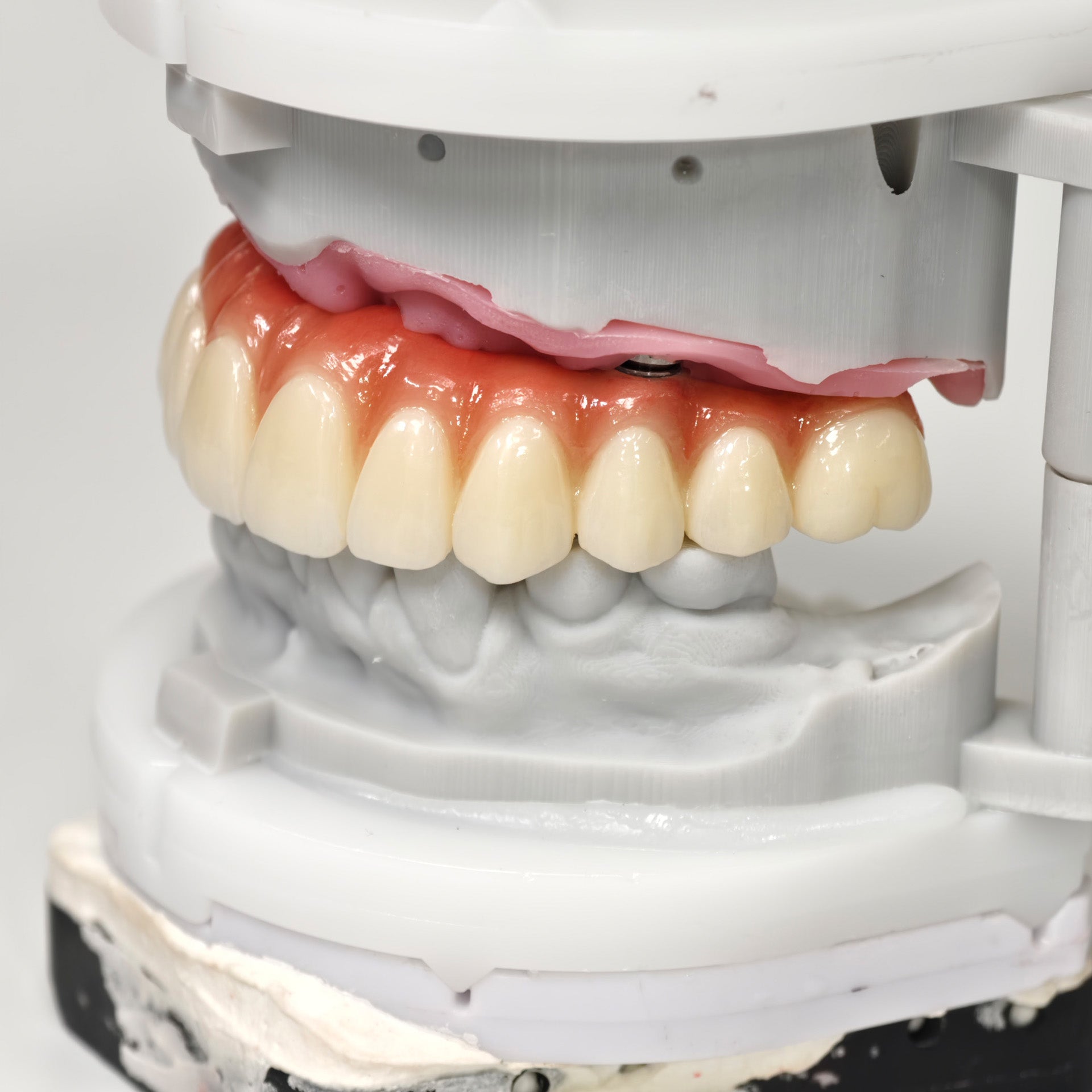 All On 6 Zirconia Bridge With Ti-Base Screw Retained