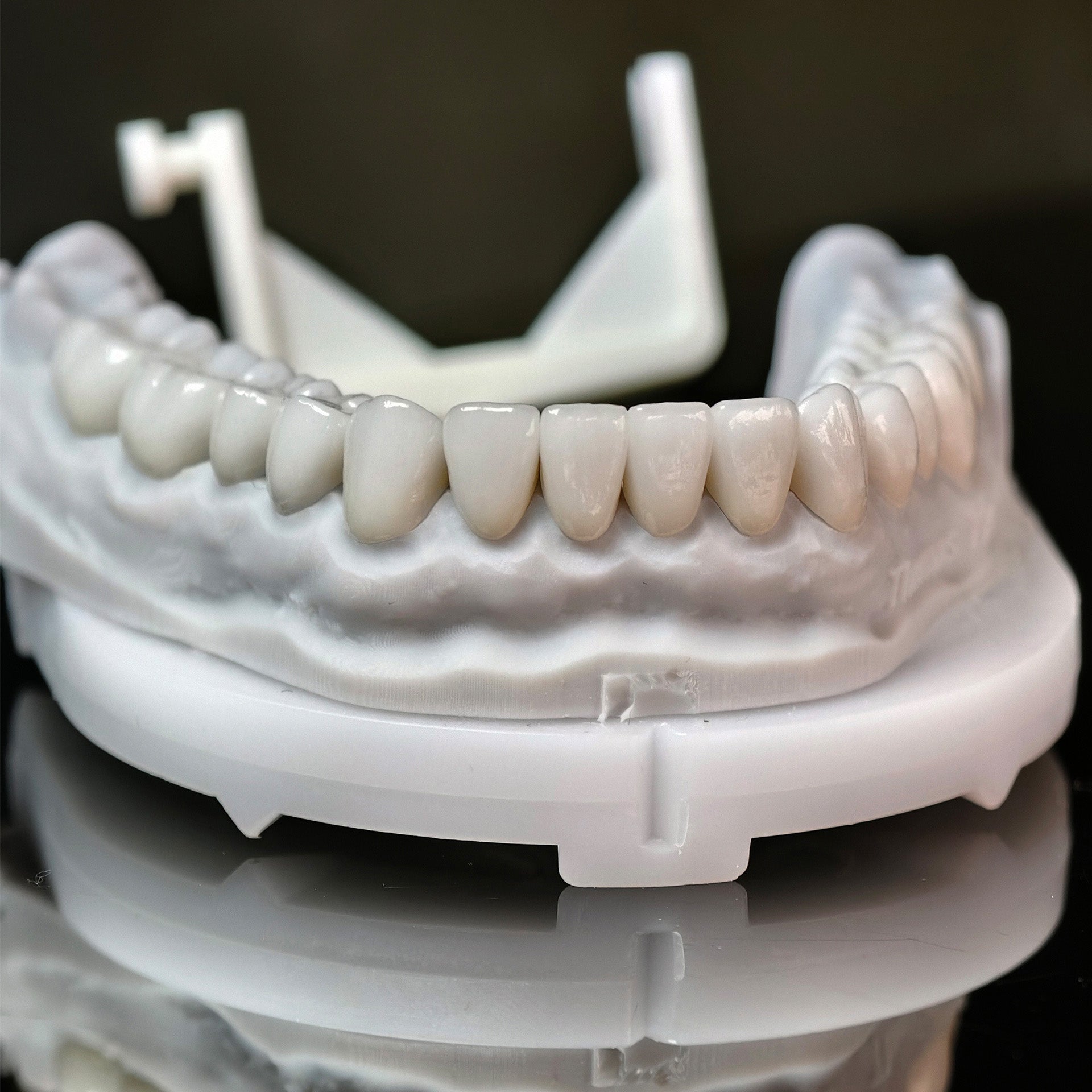 Ceramic Veneers And Crown With Cement Retained