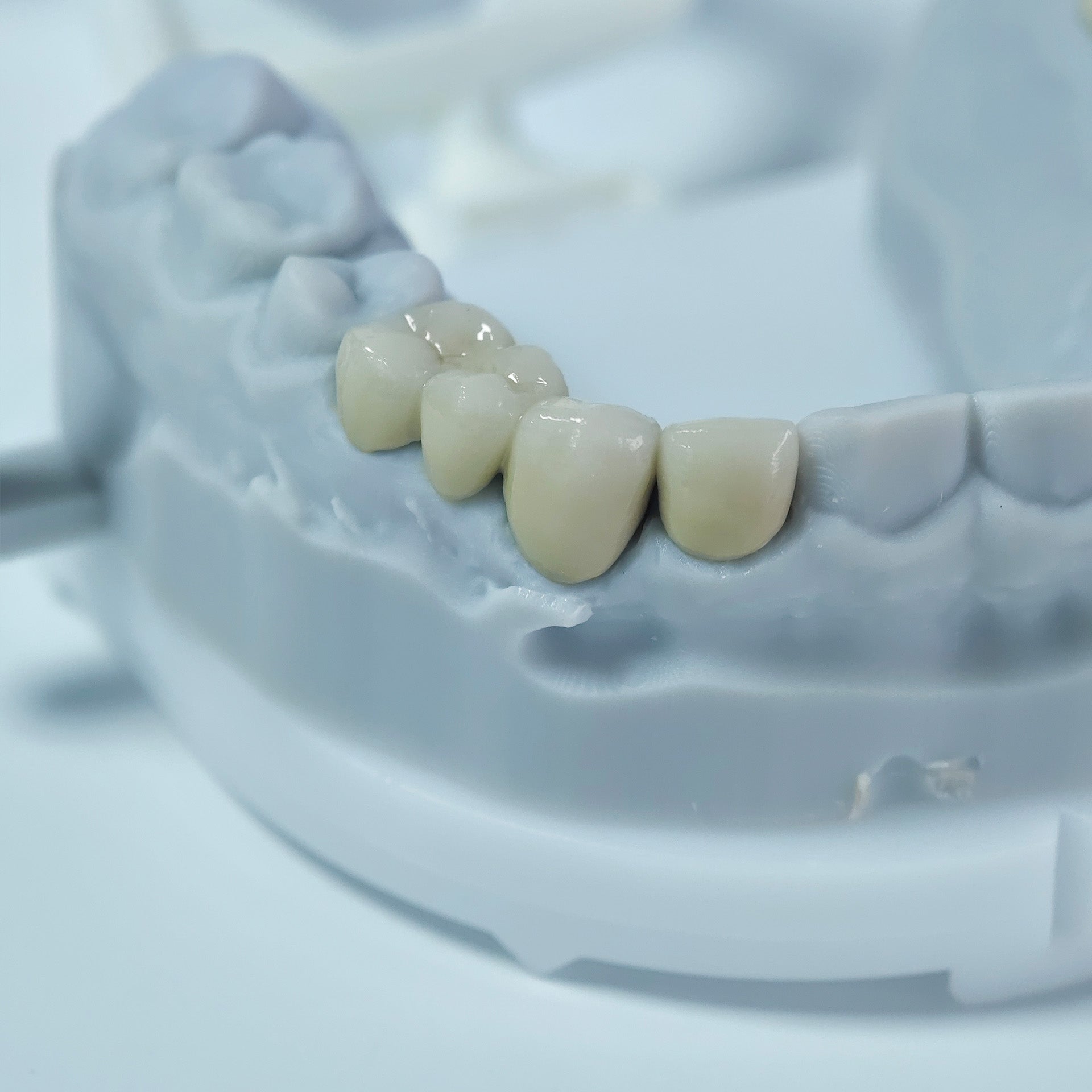 Co - Cr PFM Dental Crowns With Metal Post-And-Core