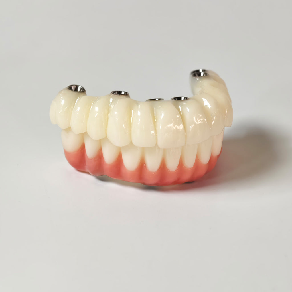 Full-Arch PMMA Bridge With Ti-Base Screw Retained