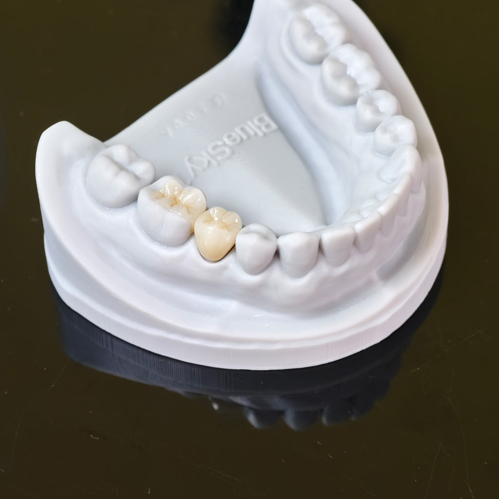 High - Strength Zirconia Inlay And Crown