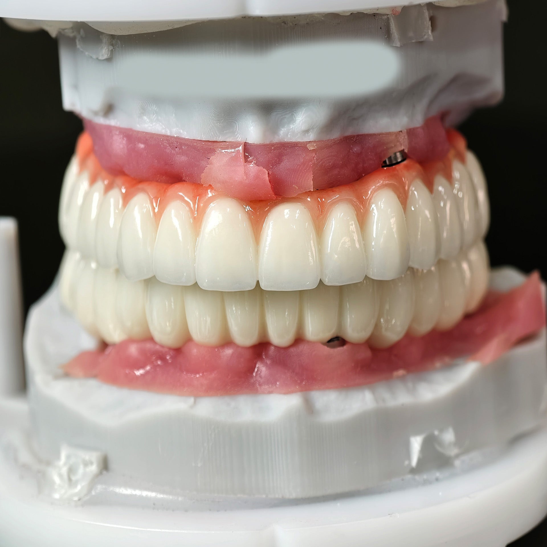 Implant-supported Co - Cr PFM Dental Bridge