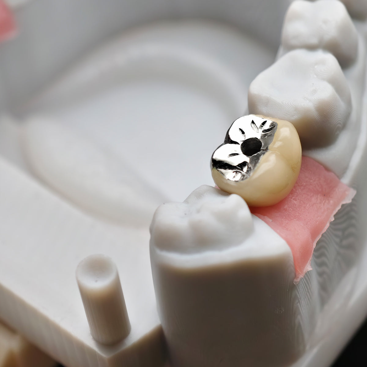 Implant-Supported PFM Single Crown With Metal