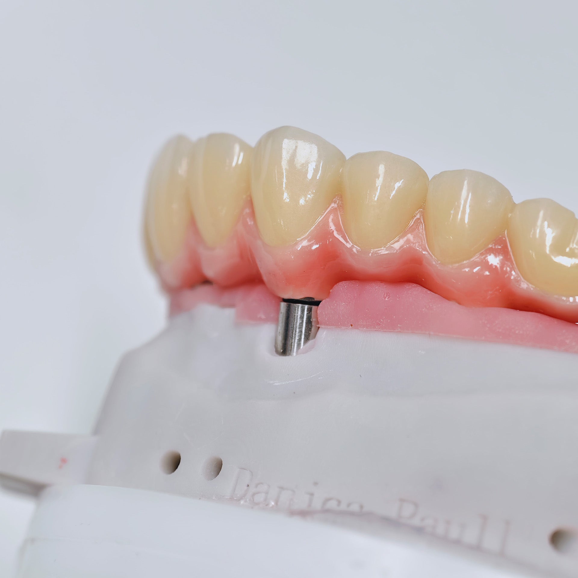 Malo Bridge With Screw-Retained