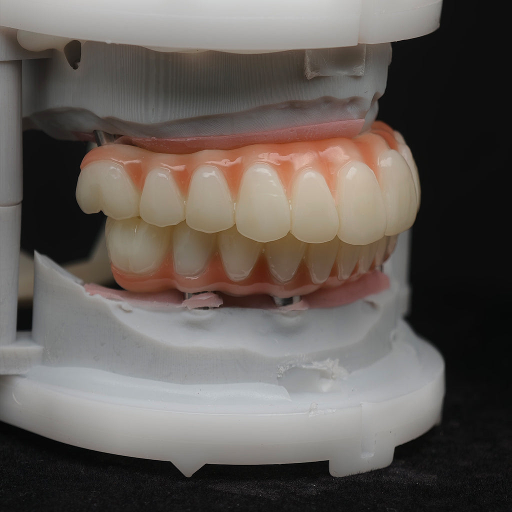 PMMA Bridge With Ti-Base Screw Retained Trying For Full Arch Restoration