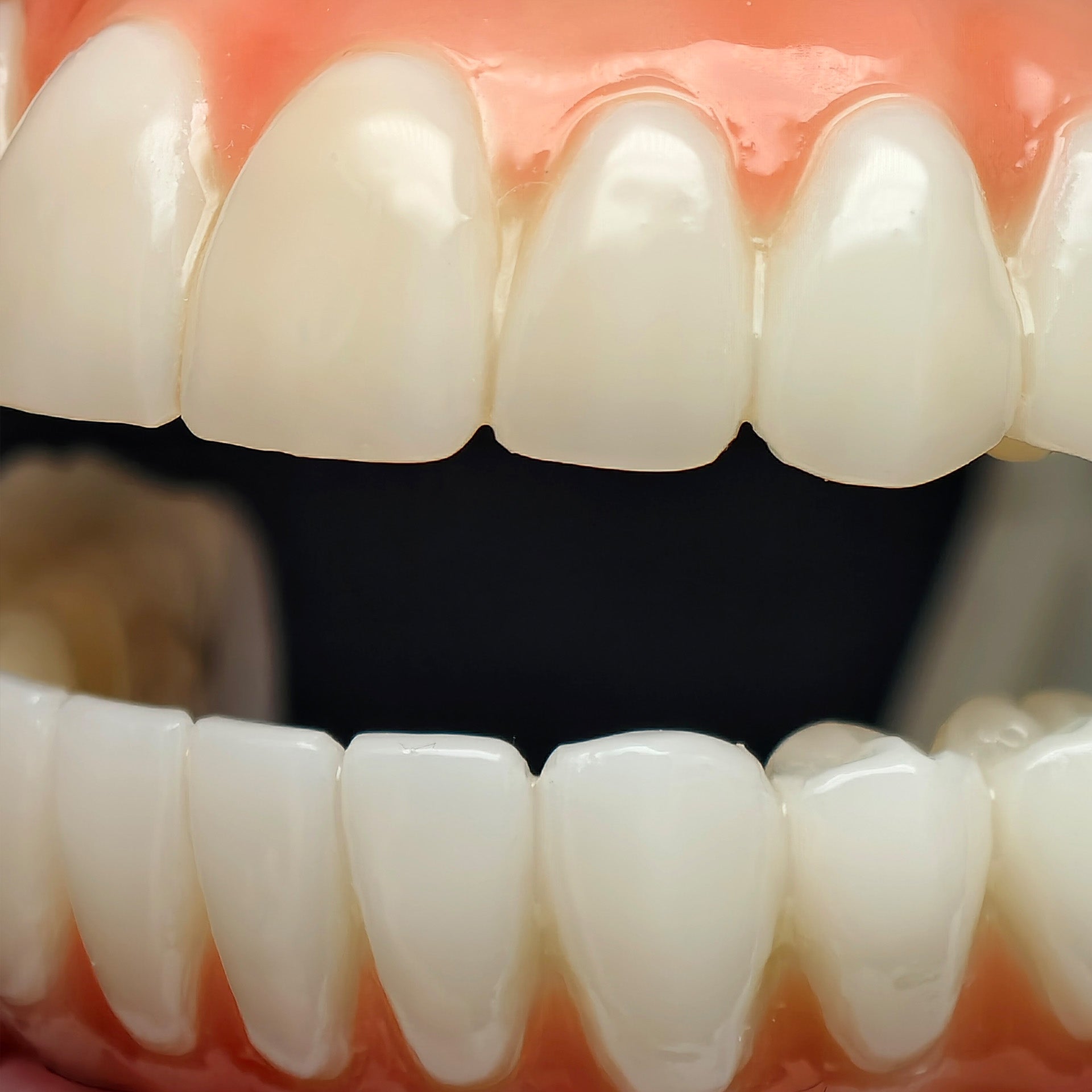 PMMA Bridge With Ti-Base Screw Retained Trying For Full Arch Restoration
