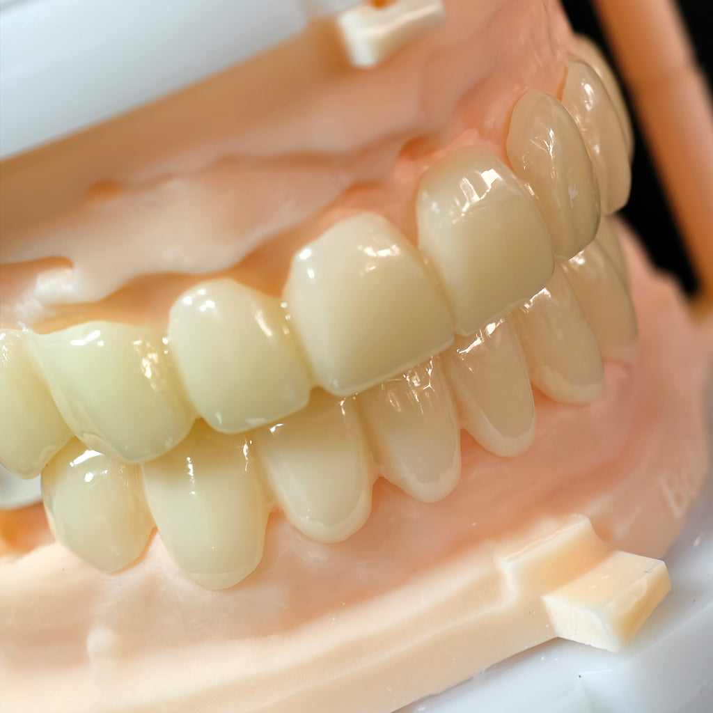 PMMA Bridge With Open Shell Preparing For Full Arch Dental Implants