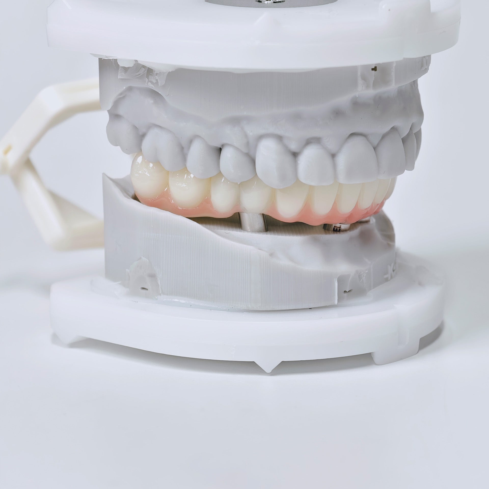 PMMA Bridge With Screw Retained