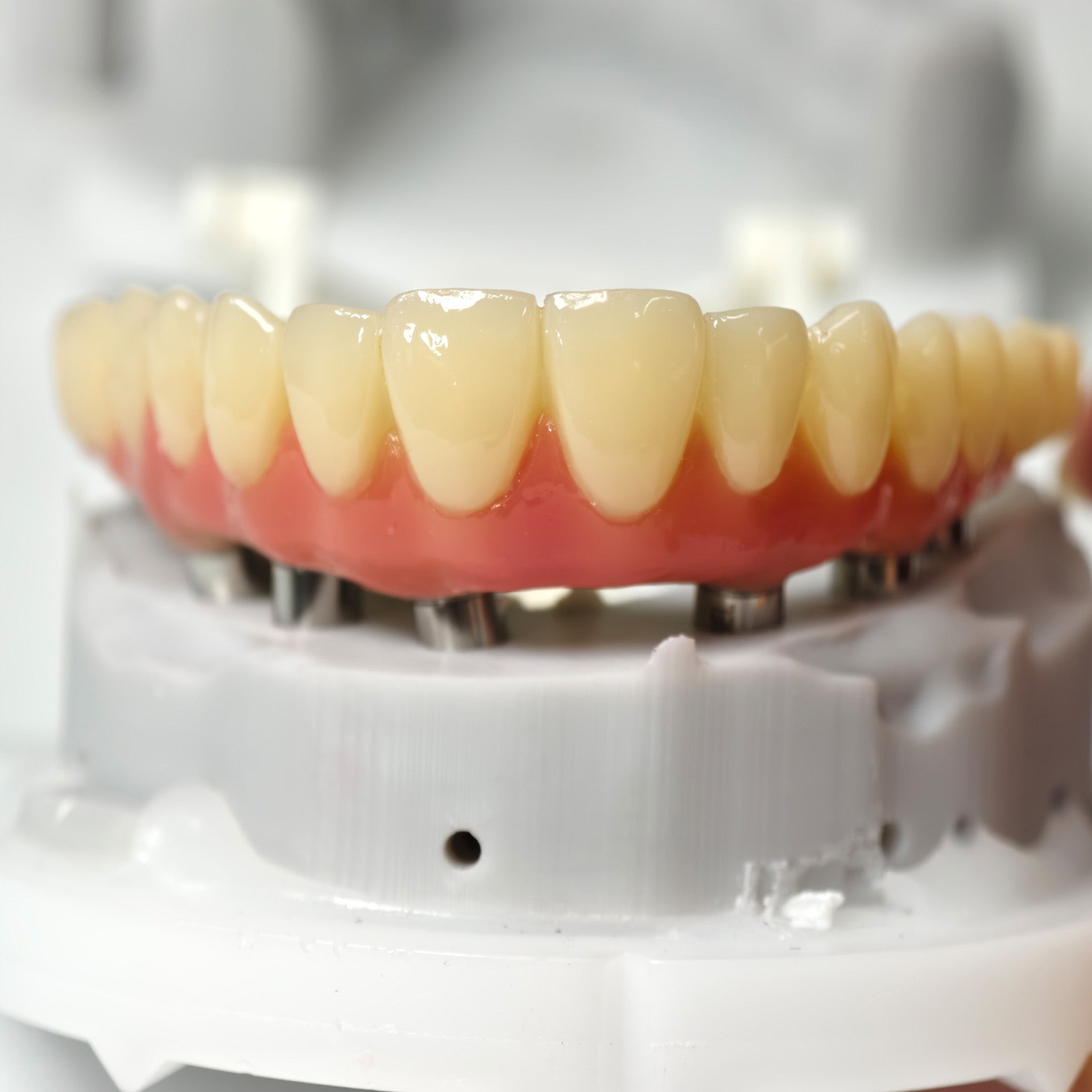 PMMA Bridge With Screw Retained