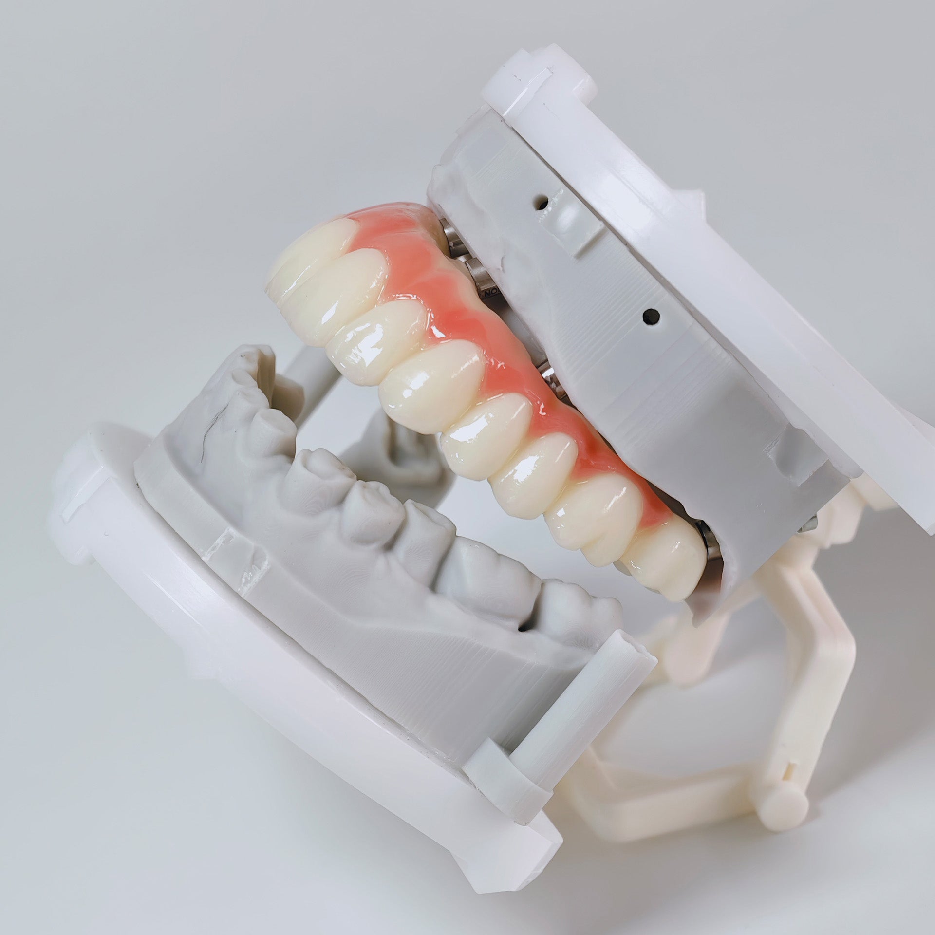 PMMA Bridge With Screw Retained