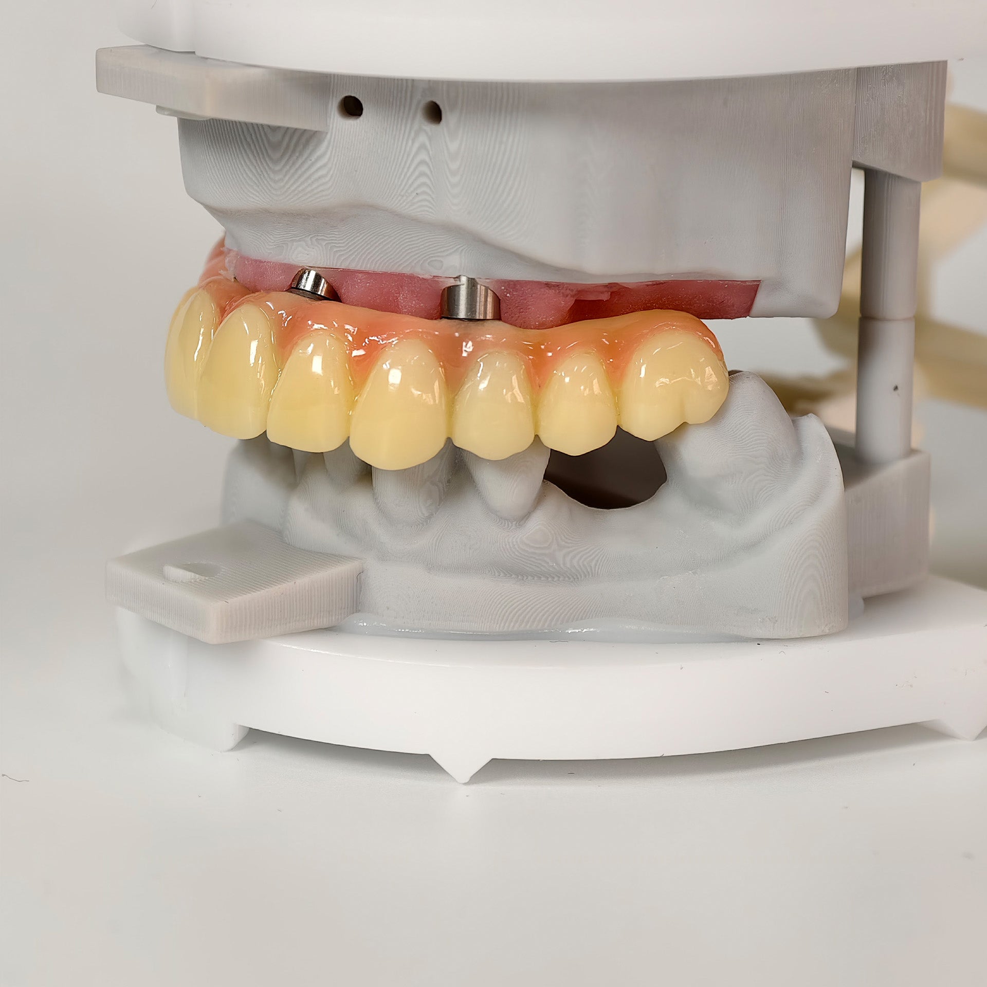 PMMA Bridge With Screw Retained