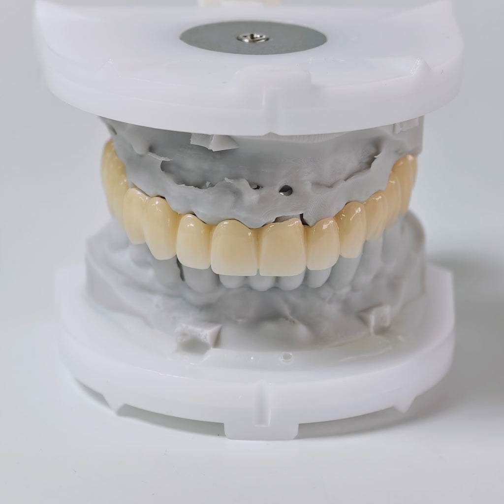 Ti-Bar Titanium Nitride Metal Frame With Zirconia Bridge And Cement Retained