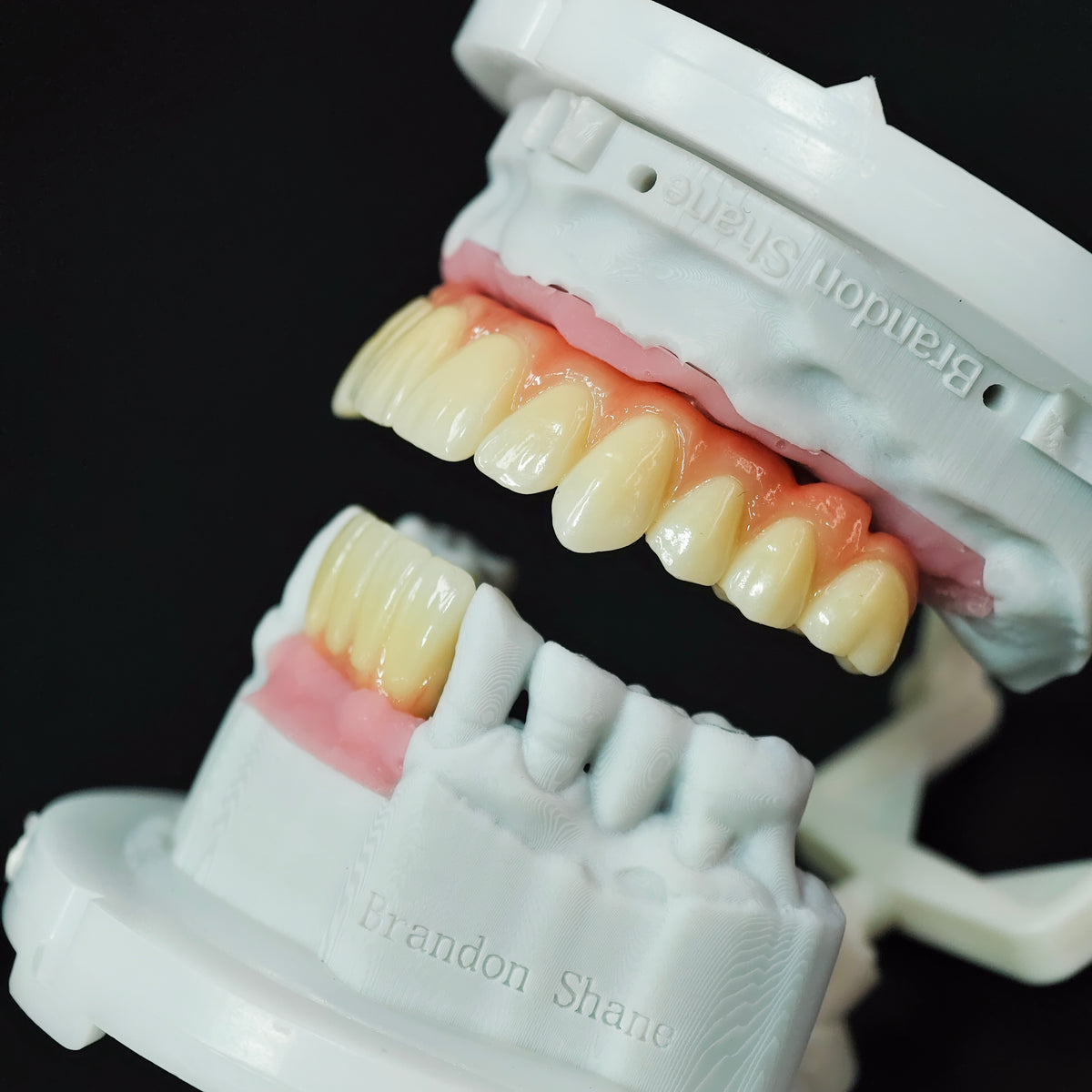 Ti-Bar Titanium Nitride Metal Frame With Zirconia Bridge For Full Arch Restoration