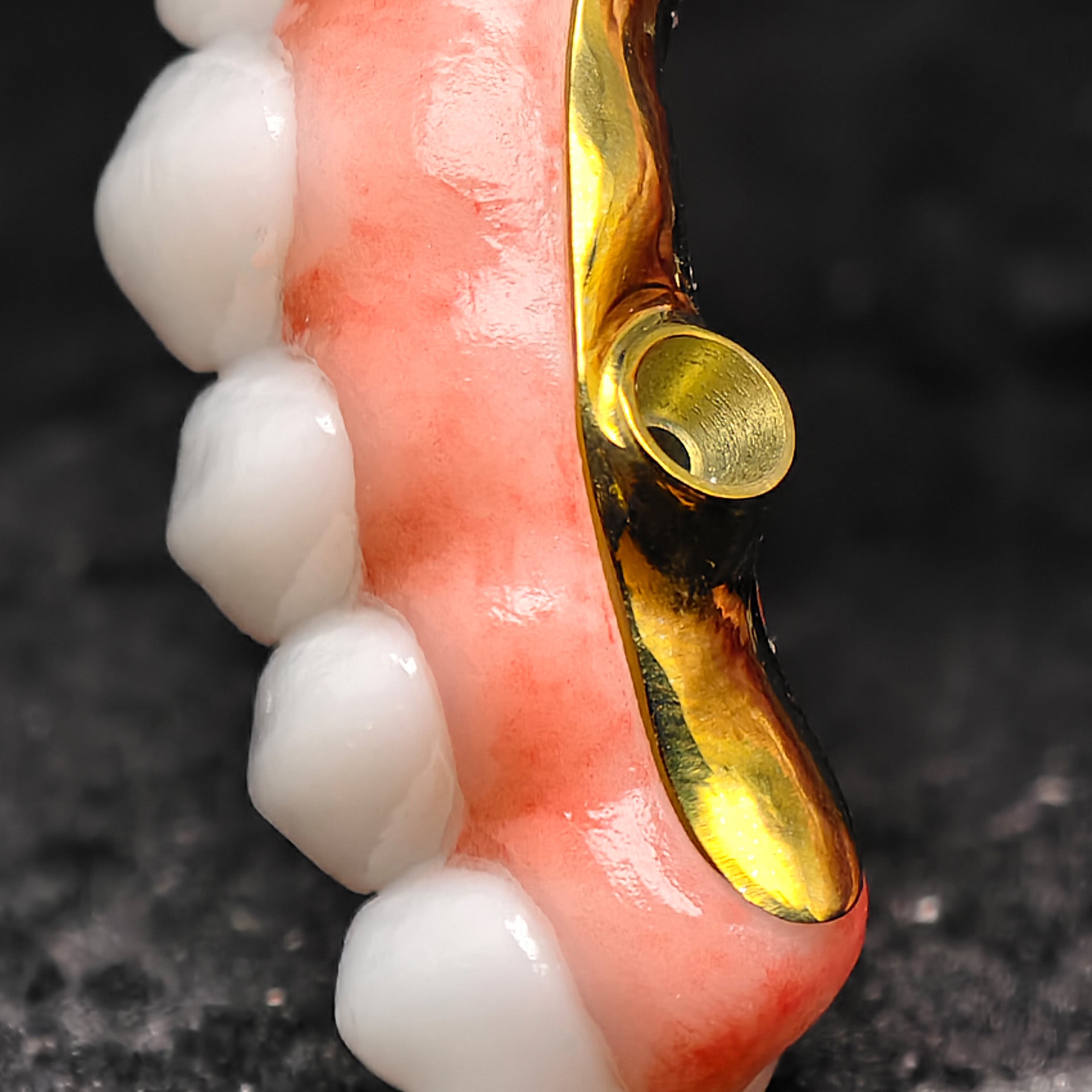 Ti-Bar Titanium Nitride Metal Frame With Zirconia Bridge For Full Arch Restoration