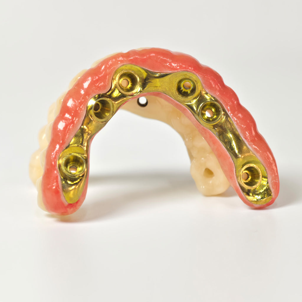 Ti-Bar Titanium Nitride Metal Frame With Zirconia Bridge For Full Arch Restoration