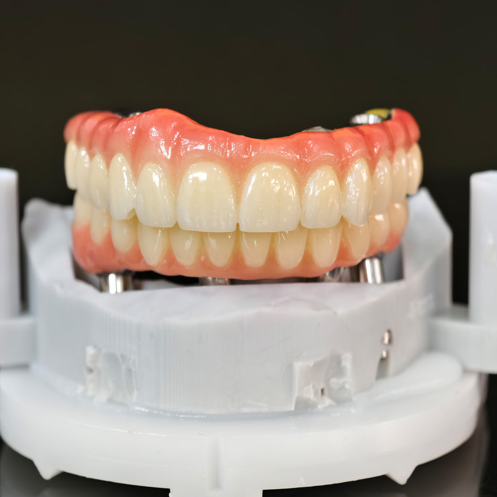 Ti-Bar Titanium Nitride Metal Frame With Zirconia Bridge For Full Arch Restoration