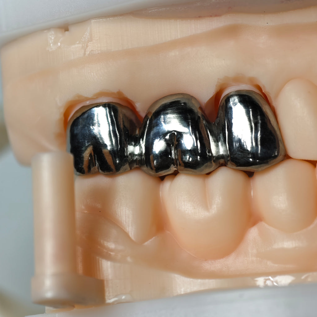 Titanium Crown With Cement Retained
