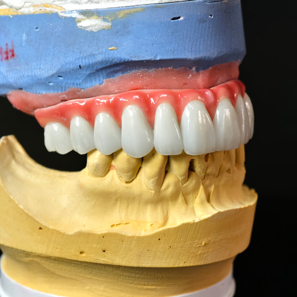 Traditional Malo Bridge With Alloy Framework Covering The Gingiva