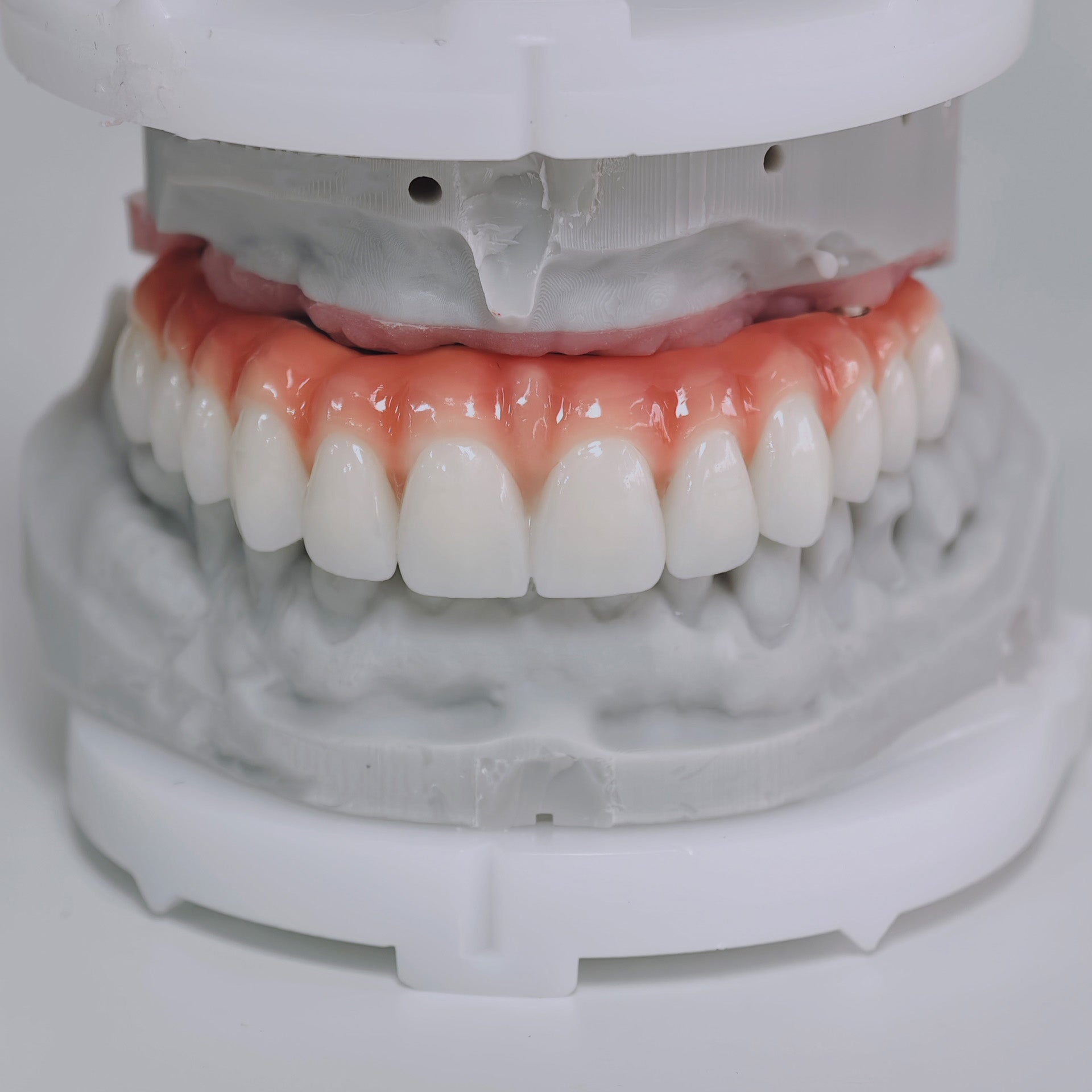 Zirconia-Enamel Hybrid Malo Bridge Aesthetic