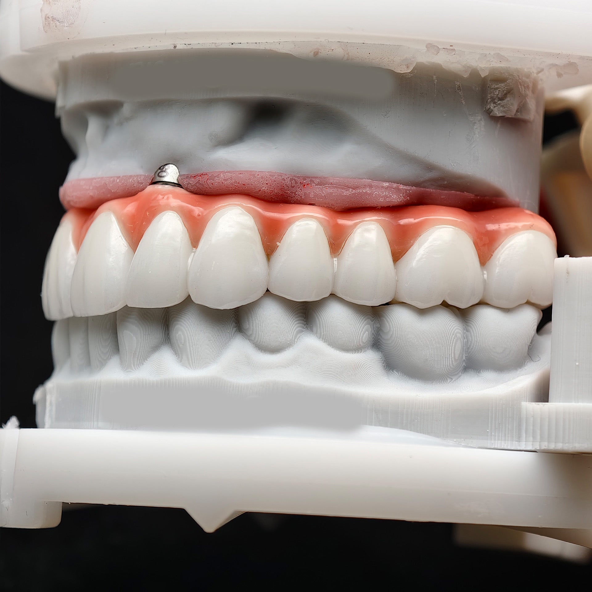 Zirconia-Enamel Hybrid Malo Bridge