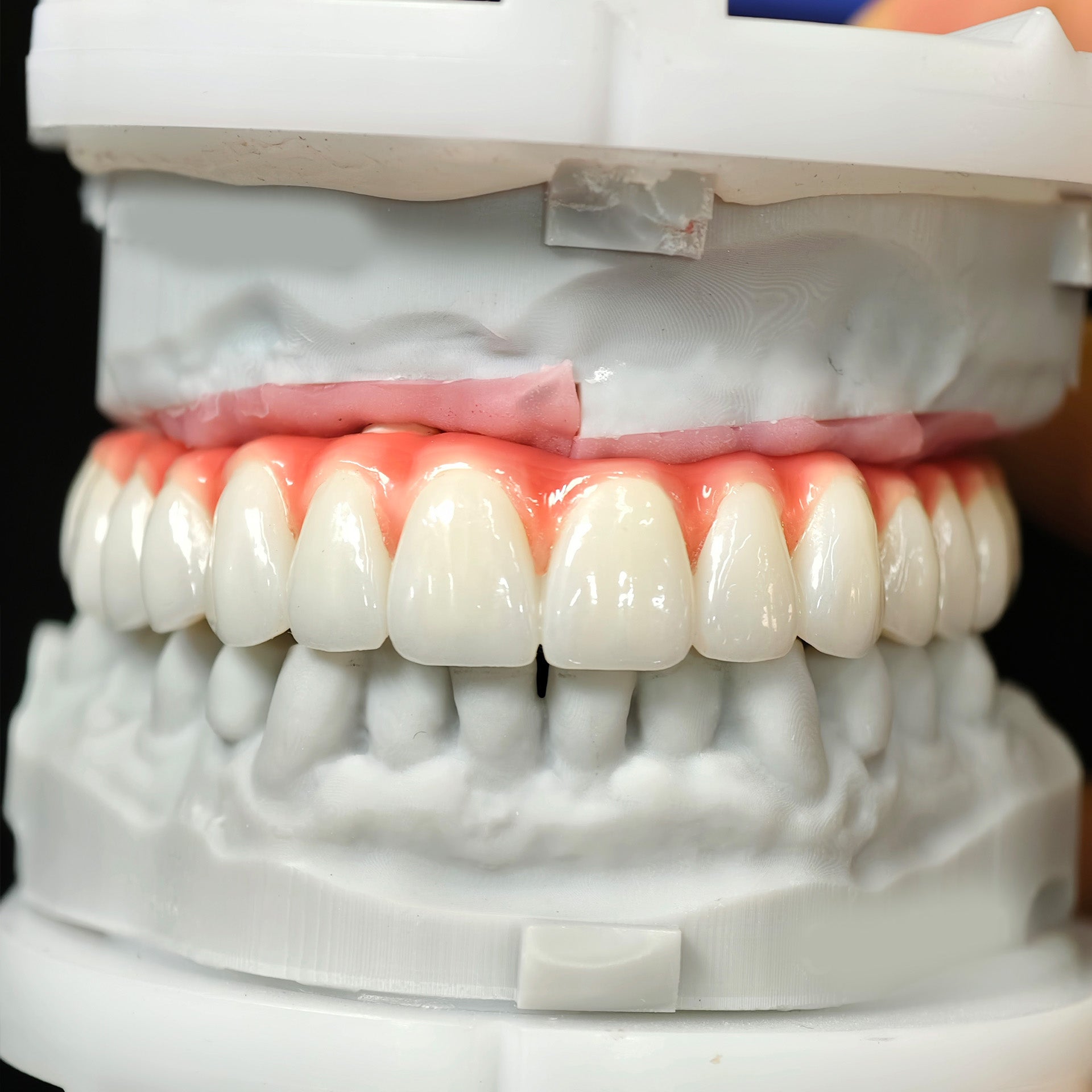 Zirconia-Enamel Hybrid Malo Bridge