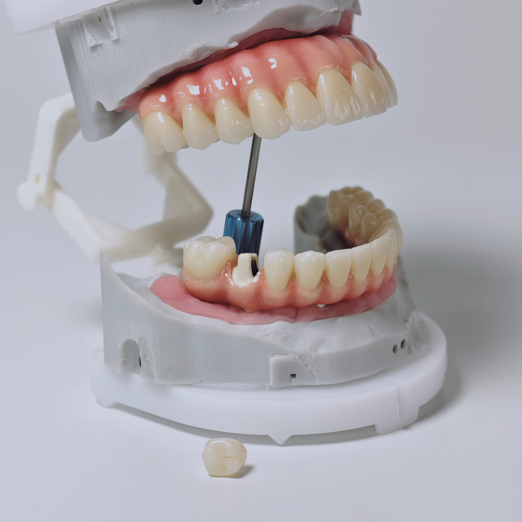 Zirconia-Enamel Hybrid Malo Bridge