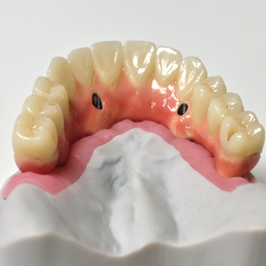Zirconia-Enamel Hybrid Malo Bridge