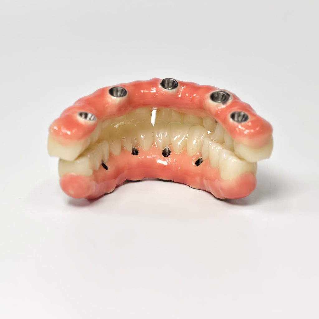 Zirconia-Enamel Hybrid Malo Bridge