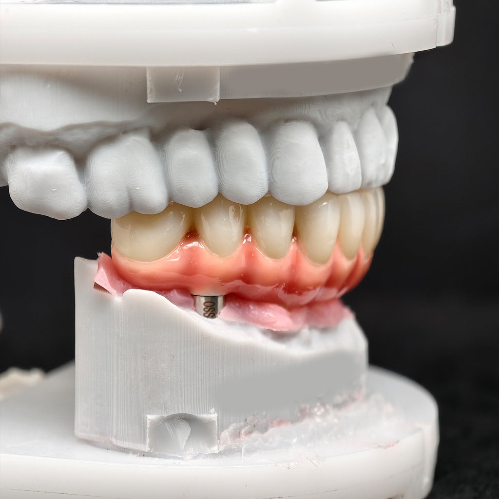 Zirconia-Enamel Hybrid Malo Bridge
