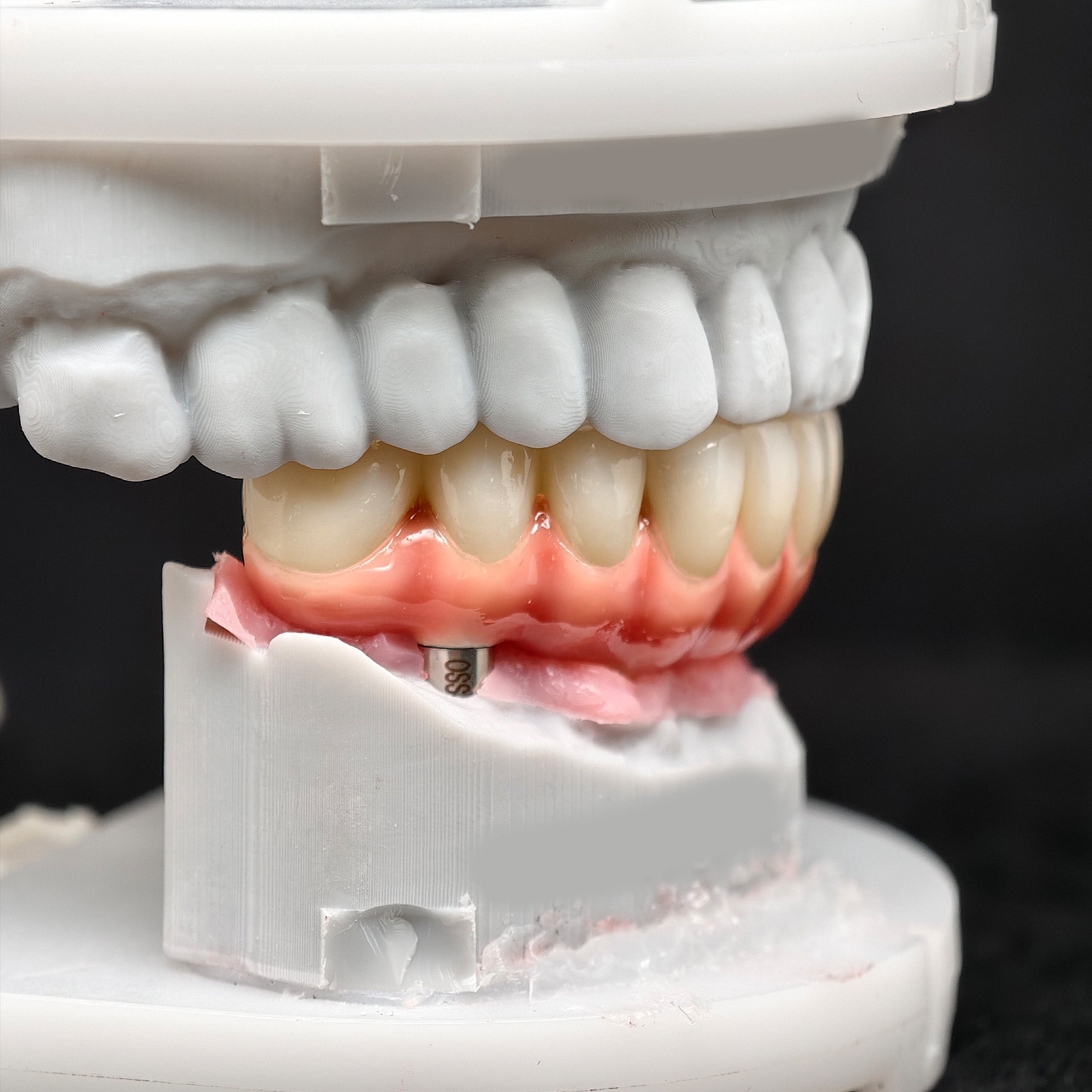 Zirconia-Enamel Hybrid Malo Bridge