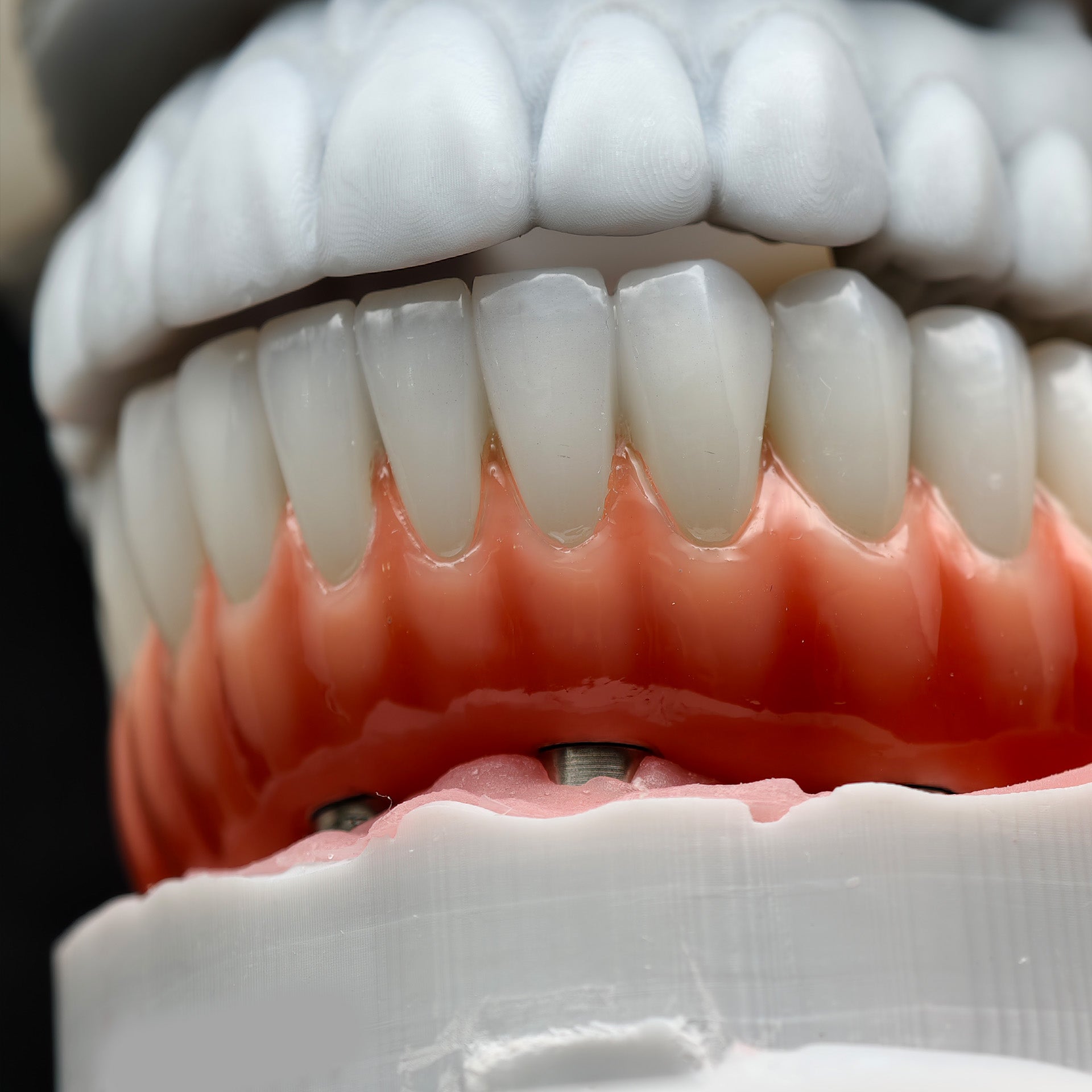 Zirconia-Enamel Hybrid Malo Bridge