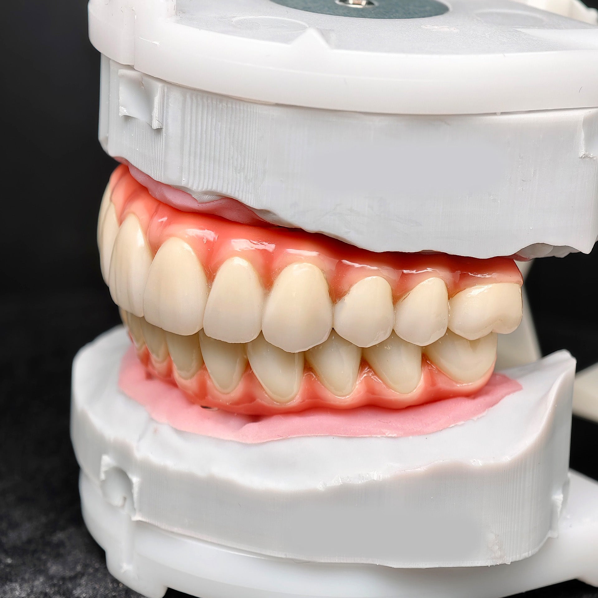 Zirconia-Enamel Hybrid Malo Bridge