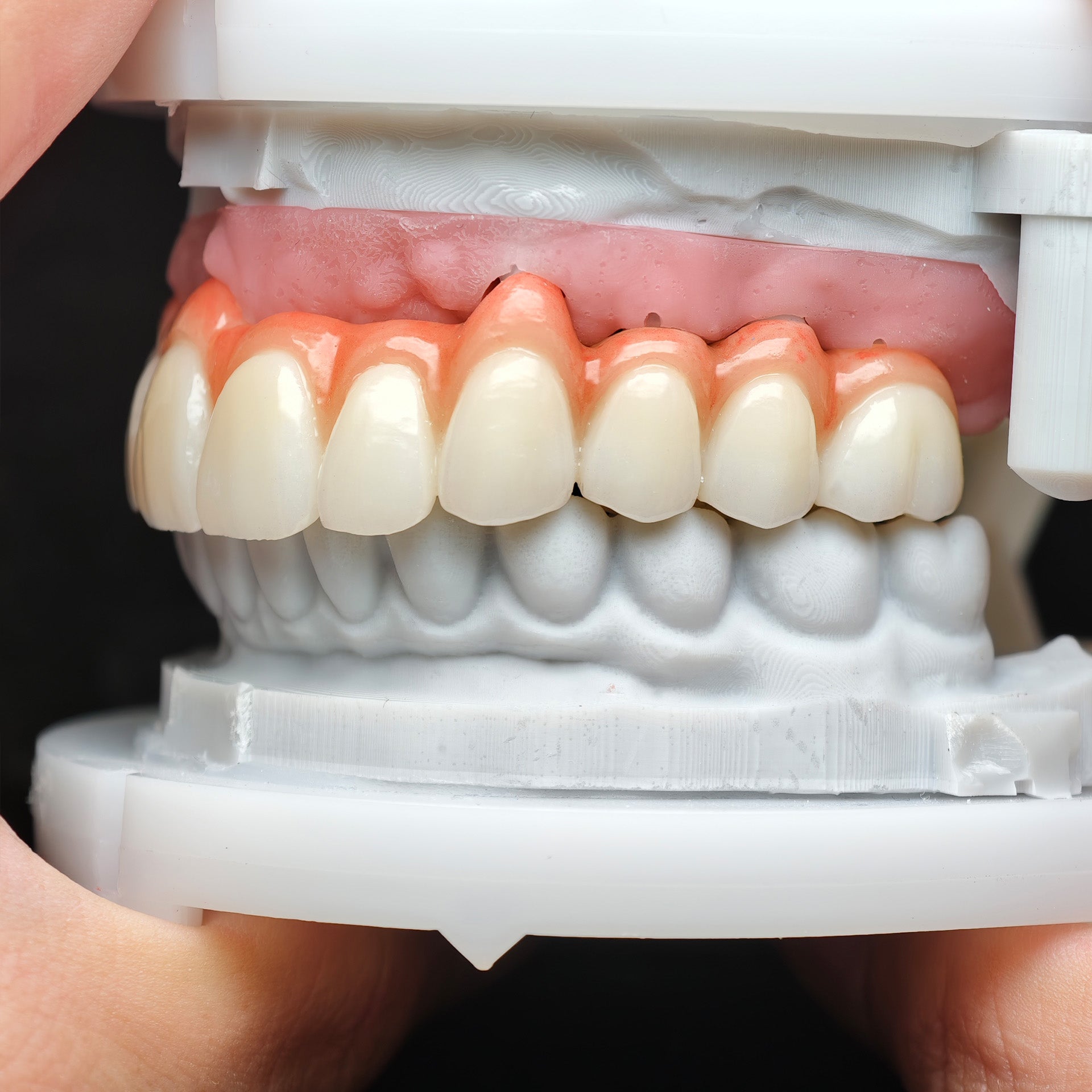 Zirconia Bridge With Cement Retained