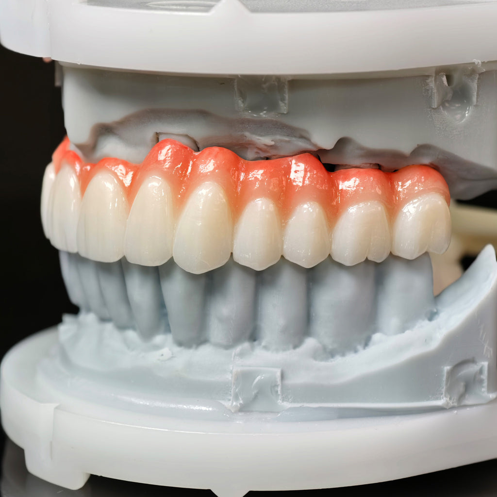 Zirconia Bridge With Cement Retained And Titanium Bar