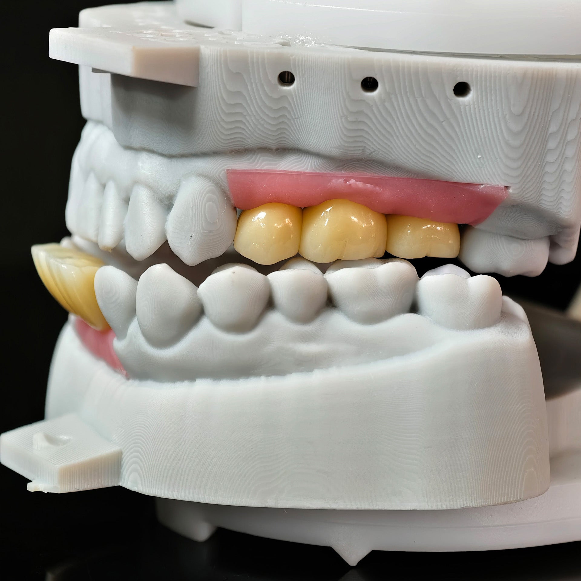 Zirconia Crowns With Gold-Plated Abutment And Implant Seating Guide
